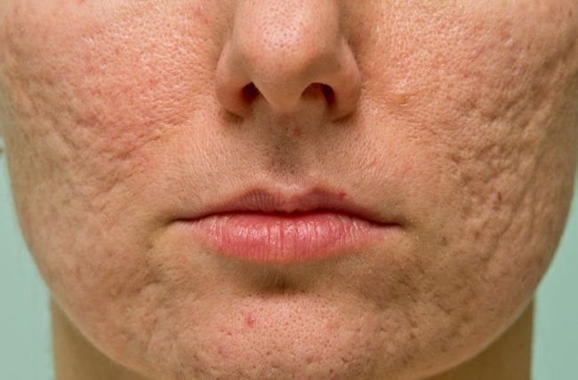 The Best Ways To Get Rid of Acne Scars – Cleveland Clinic