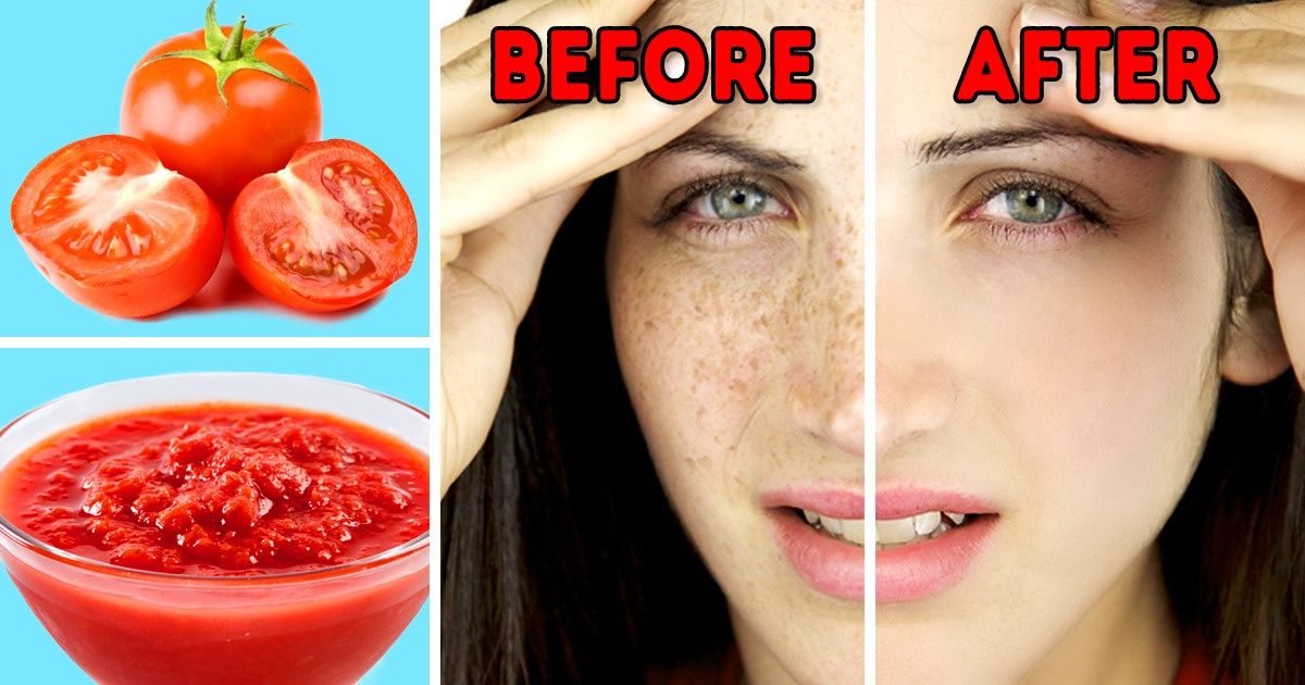 16 Tips for Removing Dark Spots From Sun on Face / Bright Side