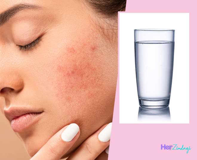 Does Drinking Water Truly Help Control Acne? Expert Explains | HerZindagi