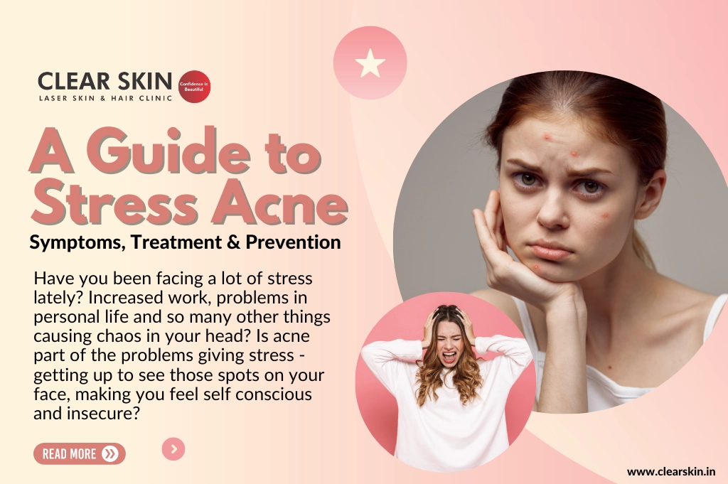 Symptoms, Treatment & Prevention of Stress Acne