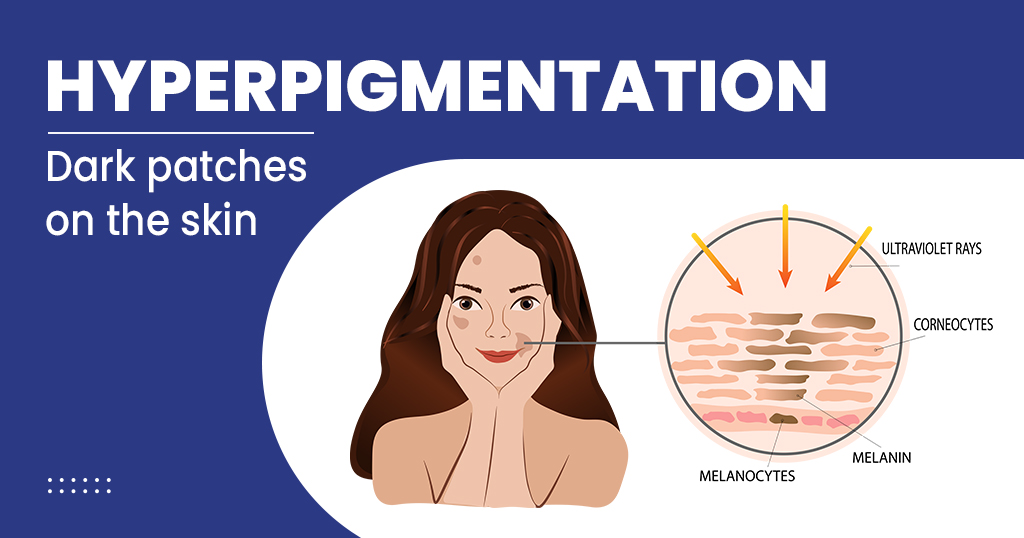 Hyperpigmentation – Types, Symptoms, Causes, Treatments and more