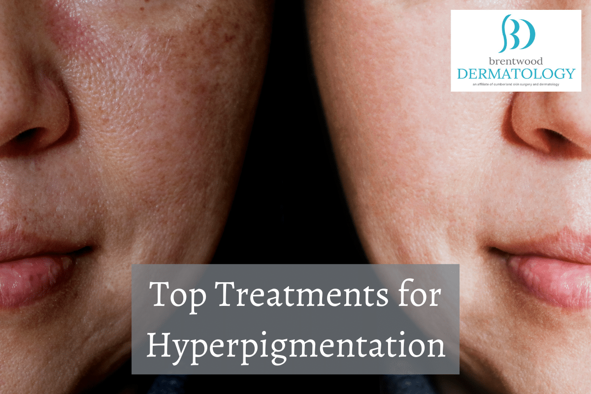 Top Treatments for Hyperpigmentation | Brentwood Dermatology