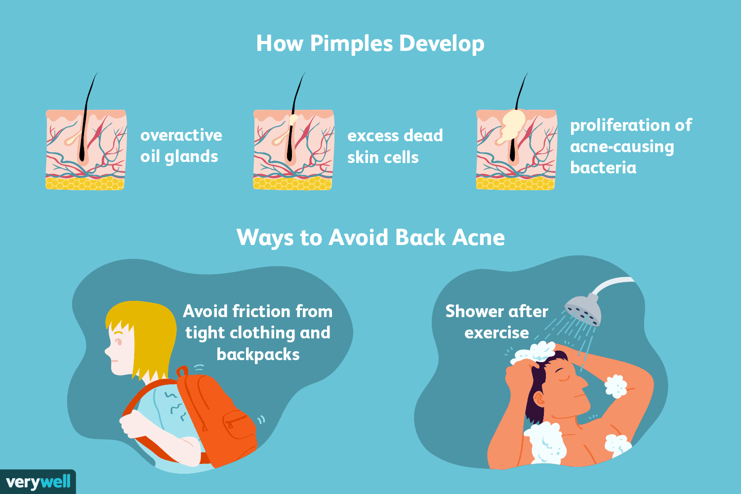 Acne: Causes and Risk Factors