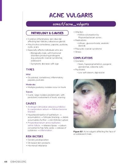 Acne vulgaris: Video, Anatomy, Definition & Function | Osmosis