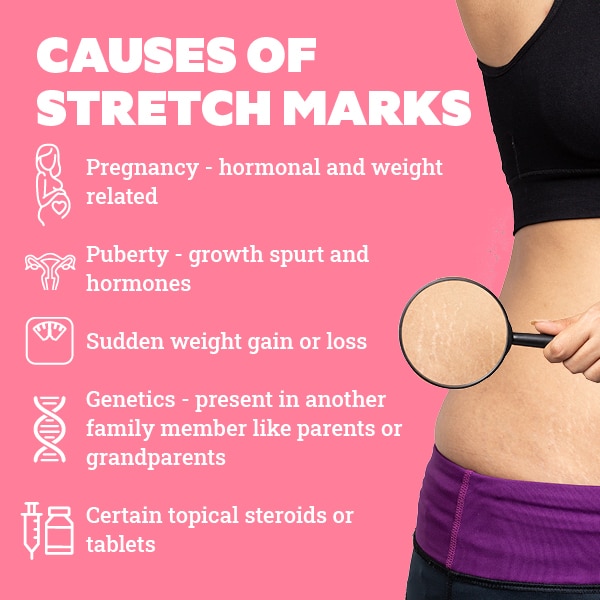 How to Deal with Stretch Marks in Teenagers | Be Beautiful India