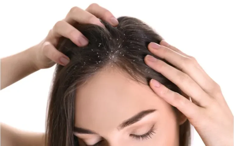 How to Get Rid of Dandruff Without Shampoo