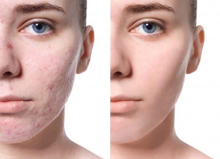 How to Get Rid of Acne Scars Without Laser Treatment