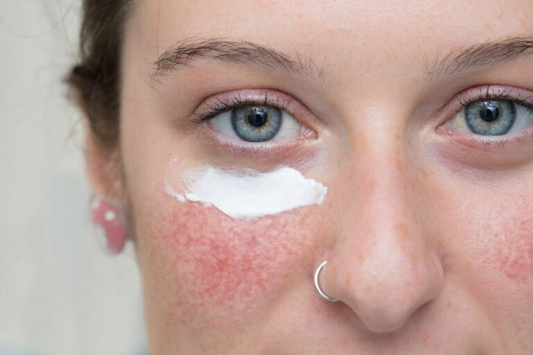 The Best Skin Care Products for Rosacea